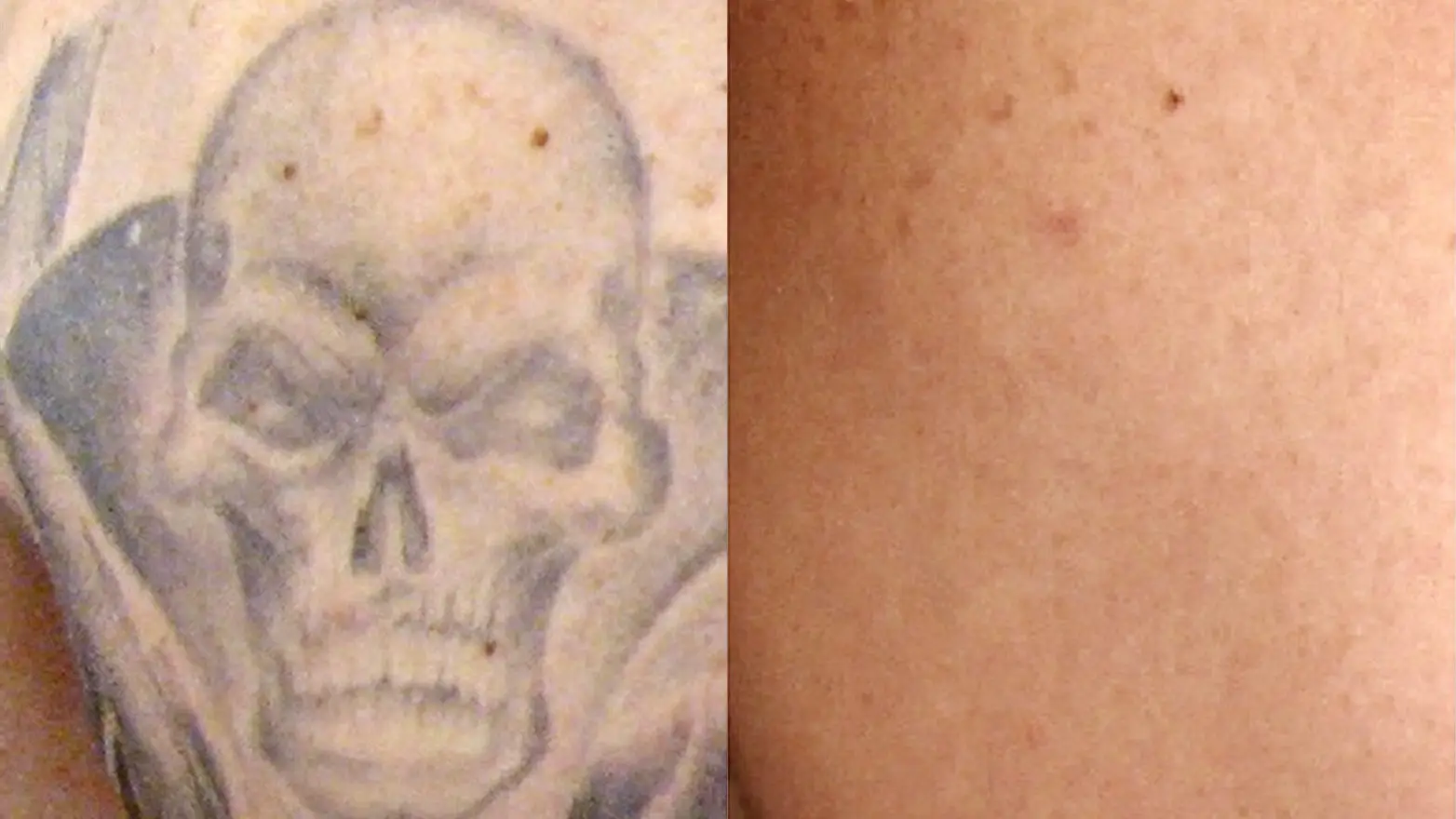 PIcosure-TattooRemoval_1