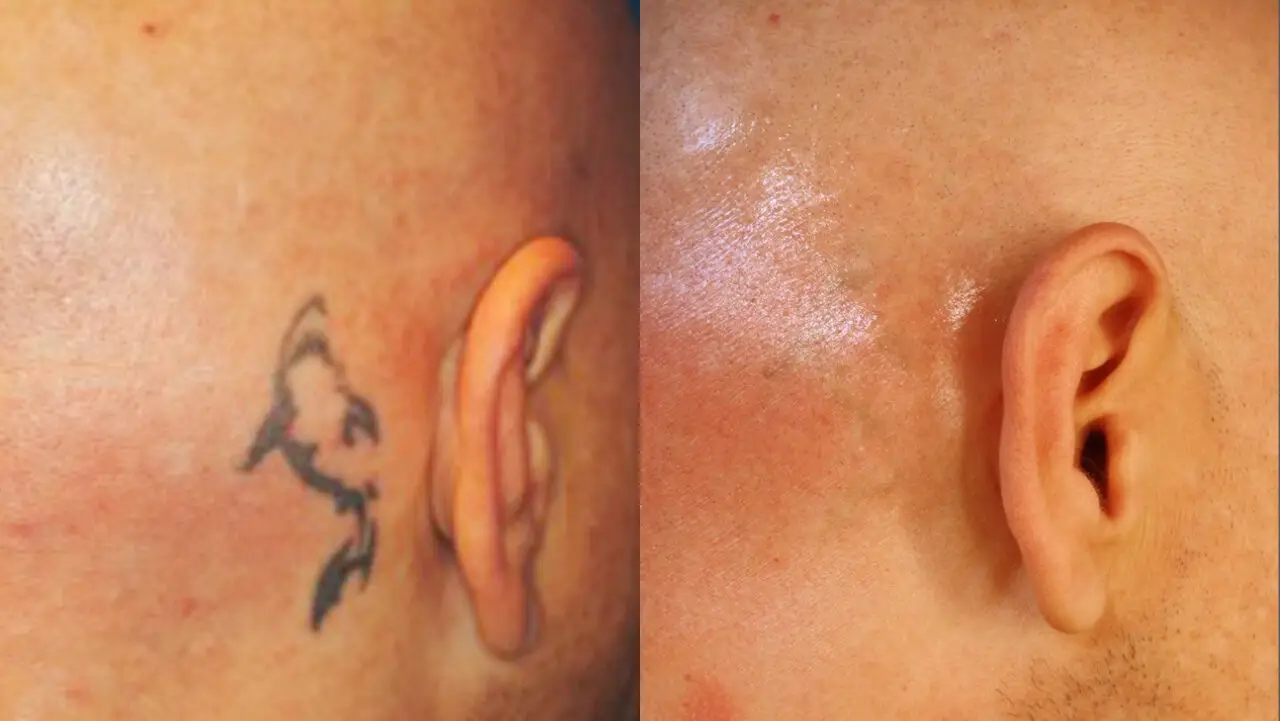 PIcosure-TattooRemoval_2