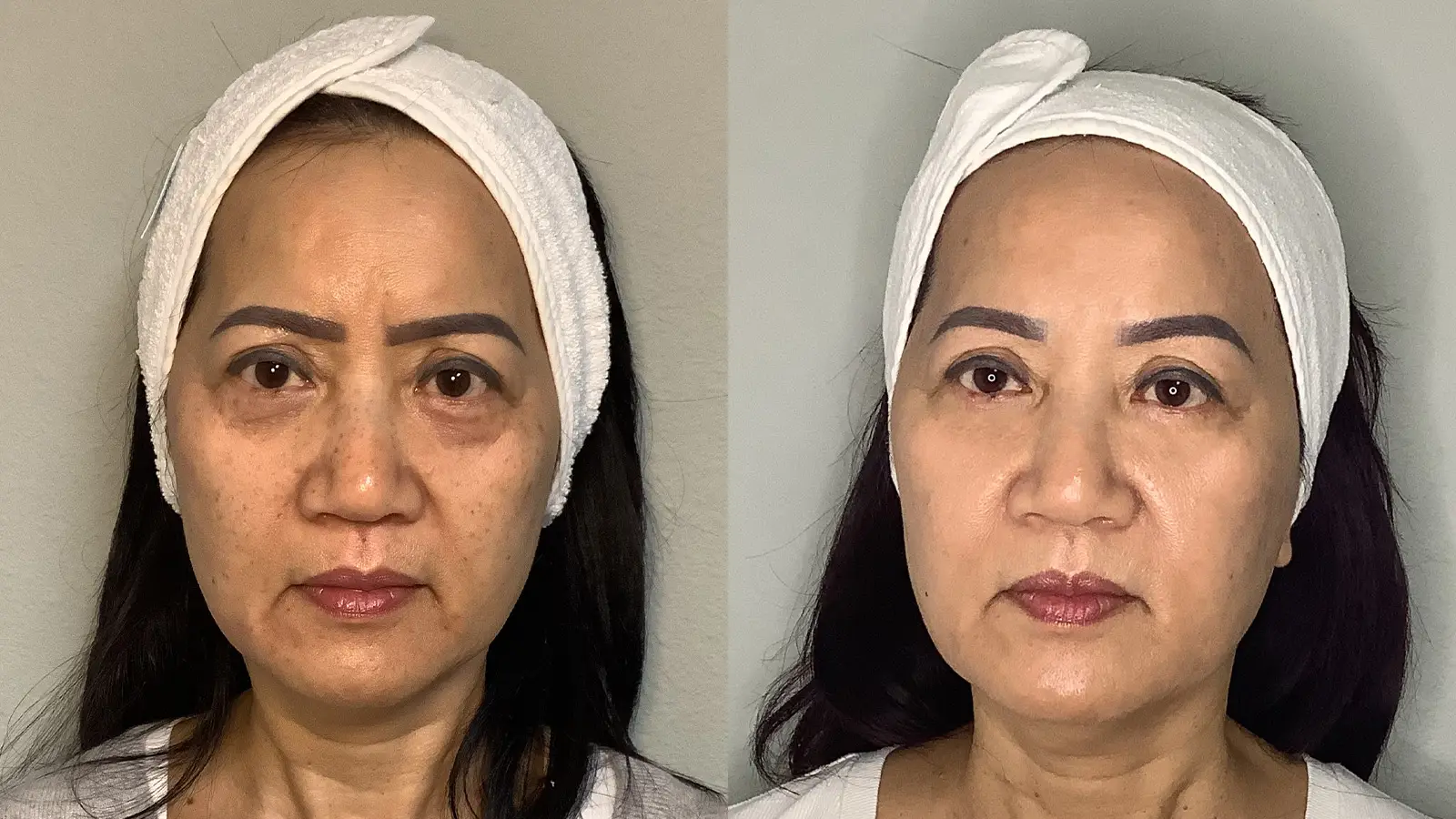 BnA-Hyperpigmentation-Full-RT