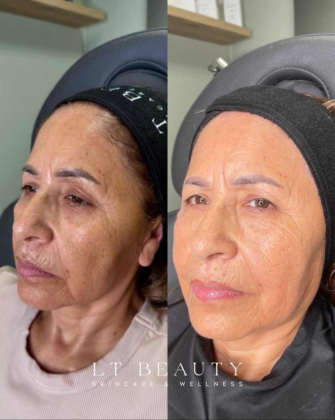 Before and after Potenza RF microneedling treatment for skin rejuvenation and collagen stimulation