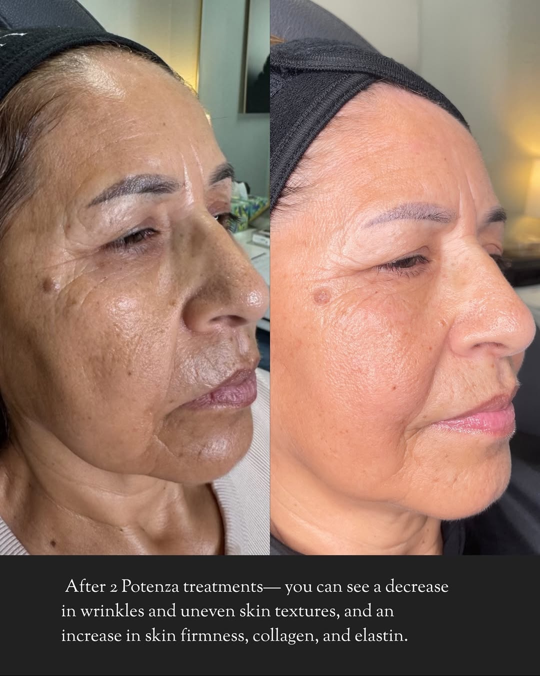 Before and after Potenza RF microneedling treatment for wrinkles, skin tightening, and improved skin texture