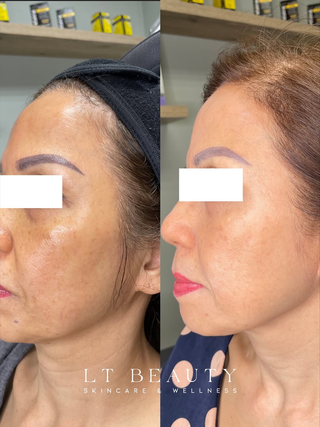 Before and after PicoSure laser treatment for hyperpigmentation, dark spots, and uneven skin texture