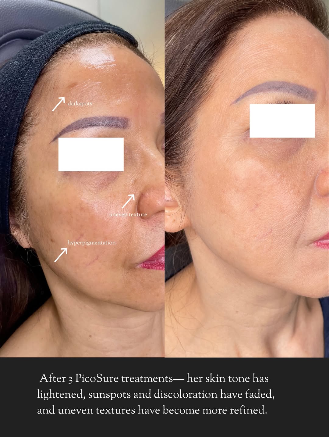 Before and after PicoSure laser treatment for hyperpigmentation, dark spots, and uneven skin texture