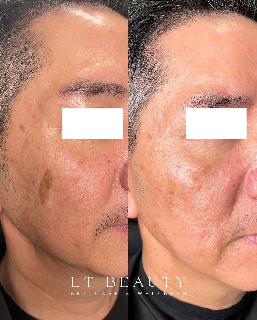 Before and after PicoSure birthmark removal treatment at LT Beauty in Westminster, CA