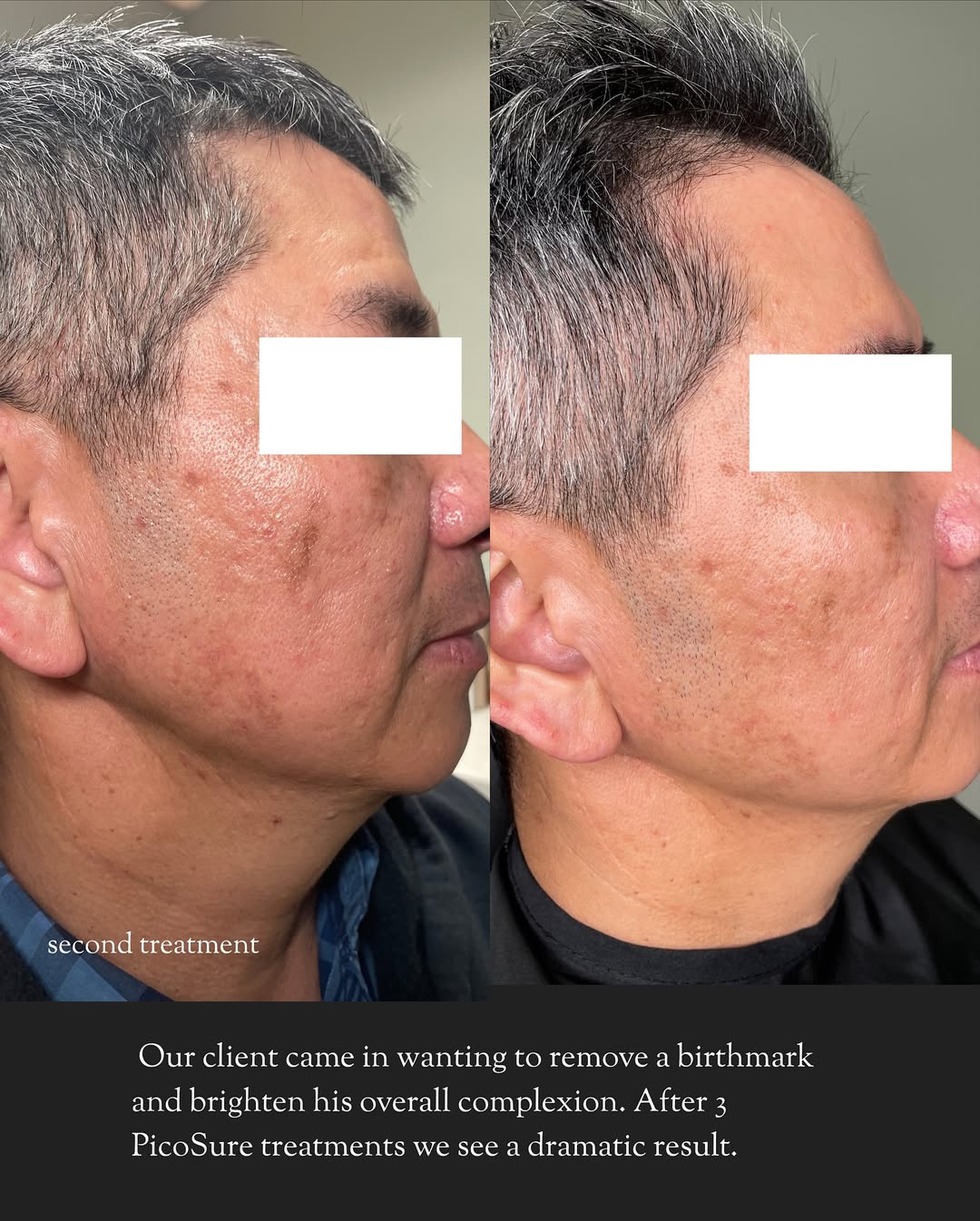Birthmark reduction and brighter skin after three PicoSure laser treatments