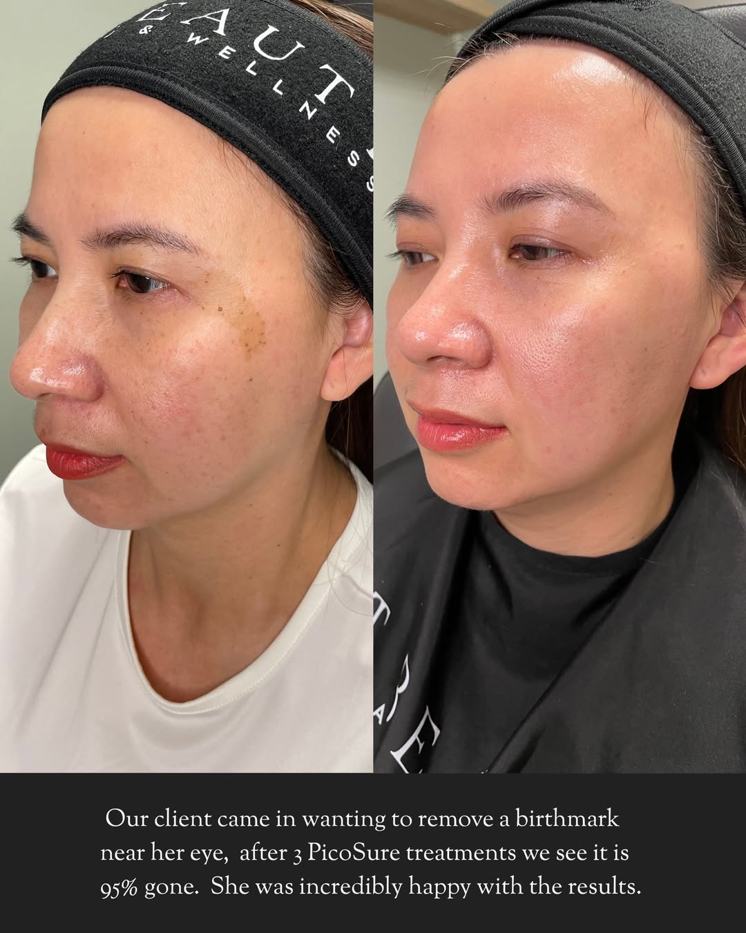 Before and after PicoSure laser treatment for birthmark removal near the eye