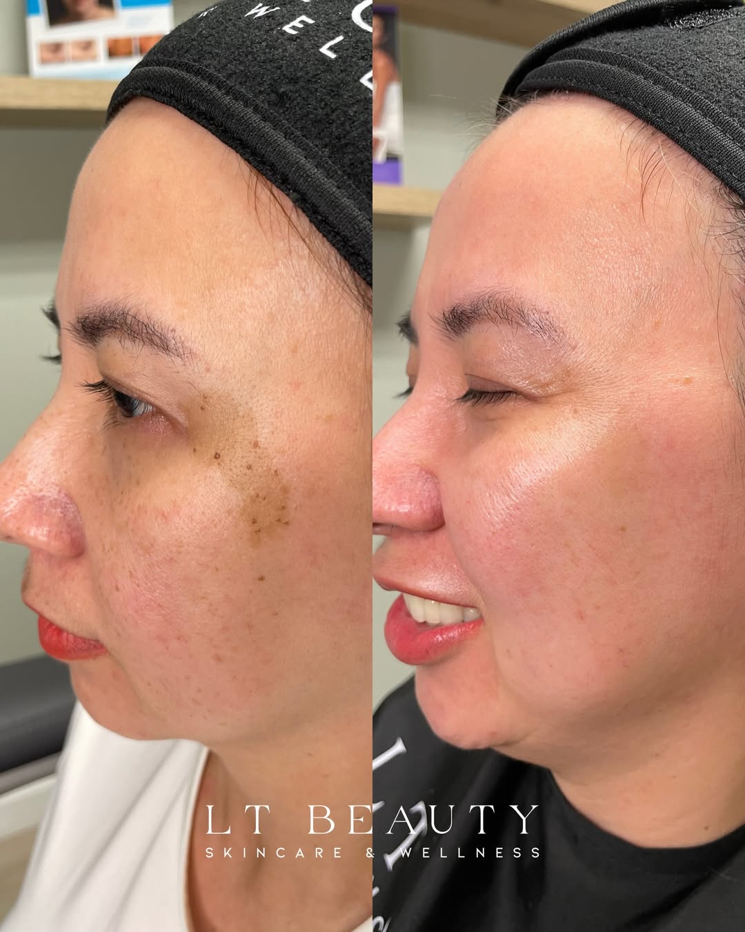 Before and after PicoSure laser treatment for melasma and hyperpigmentation in Westminster, CA at LT Beauty
