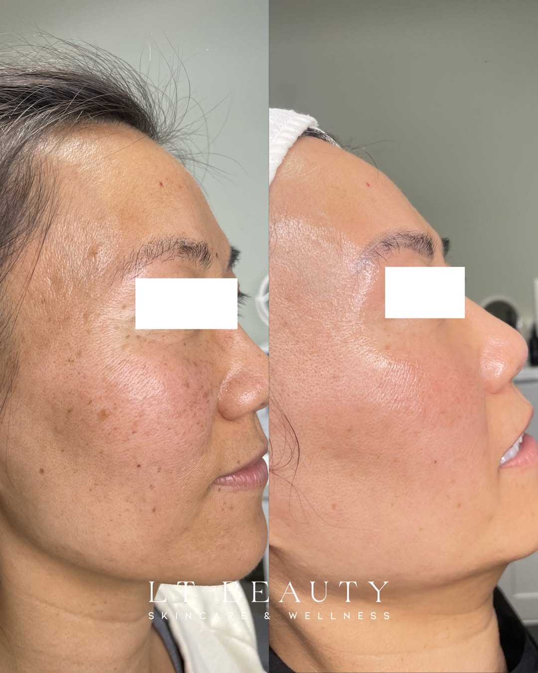 Before and after treatment for dark spots and uneven skin tone at LT Beauty in Westminster, CA