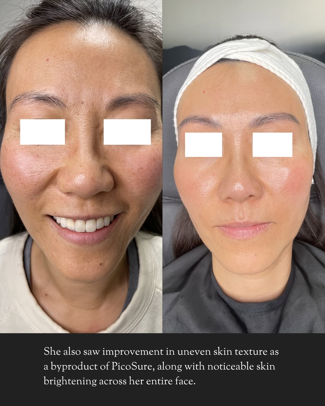 Before and after PicoSure laser treatment for uneven skin tone and brightening