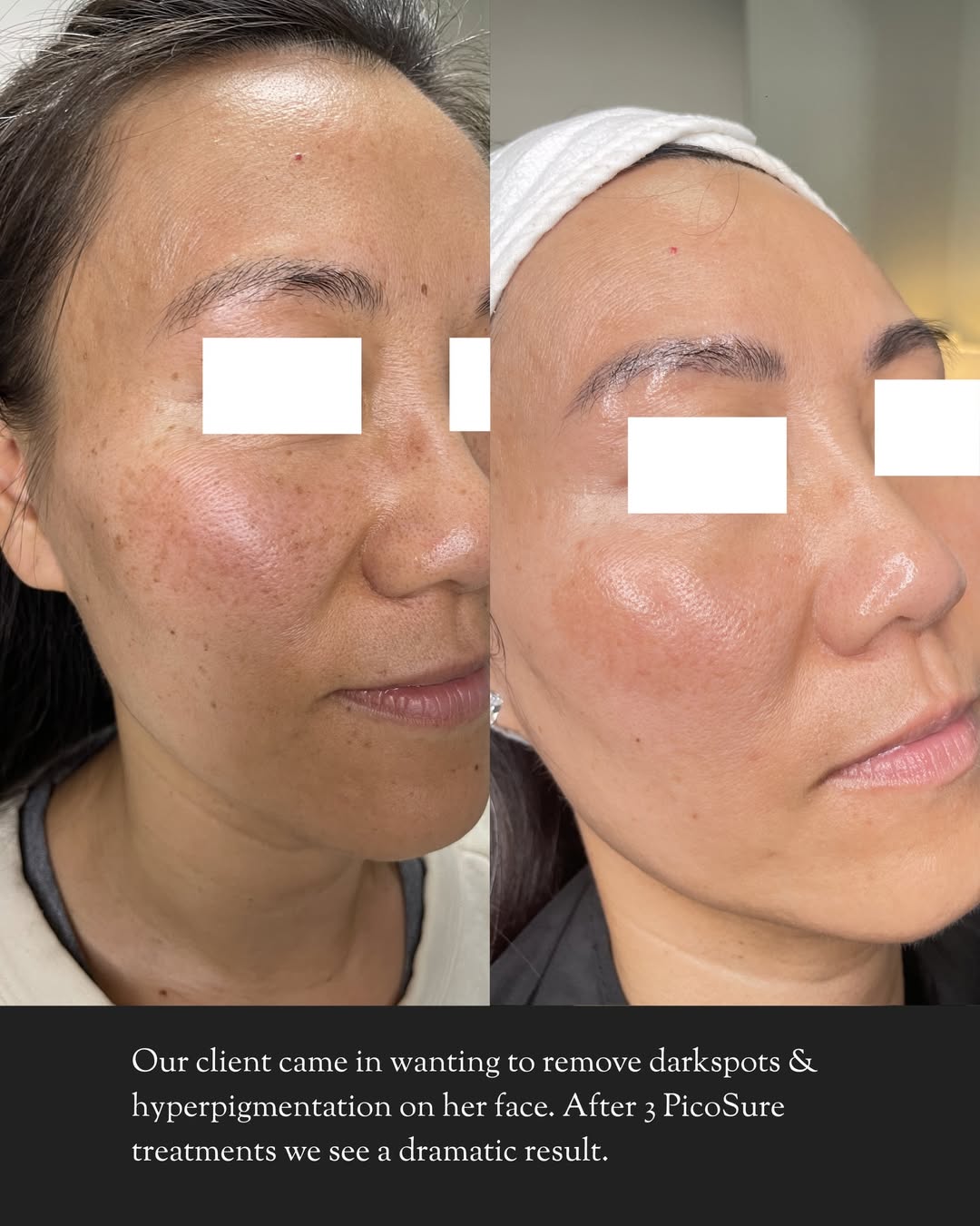 Before and after PicoSure laser treatment for dark spot and hyperpigmentation