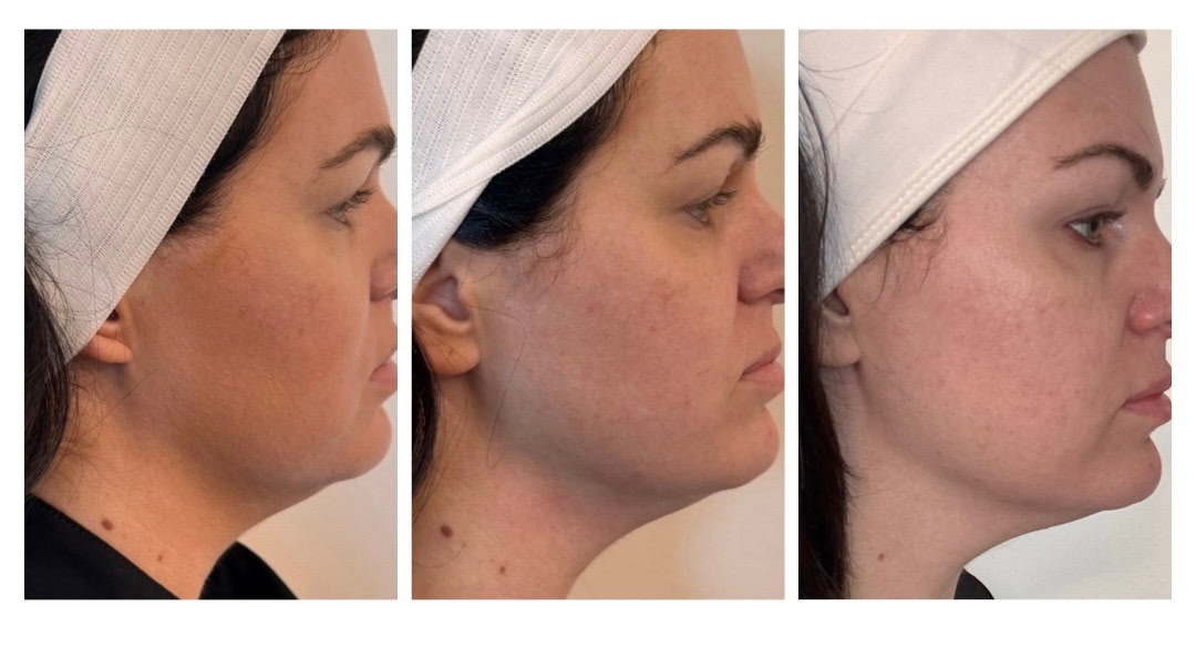 XERF before and after showing improved jawline definition