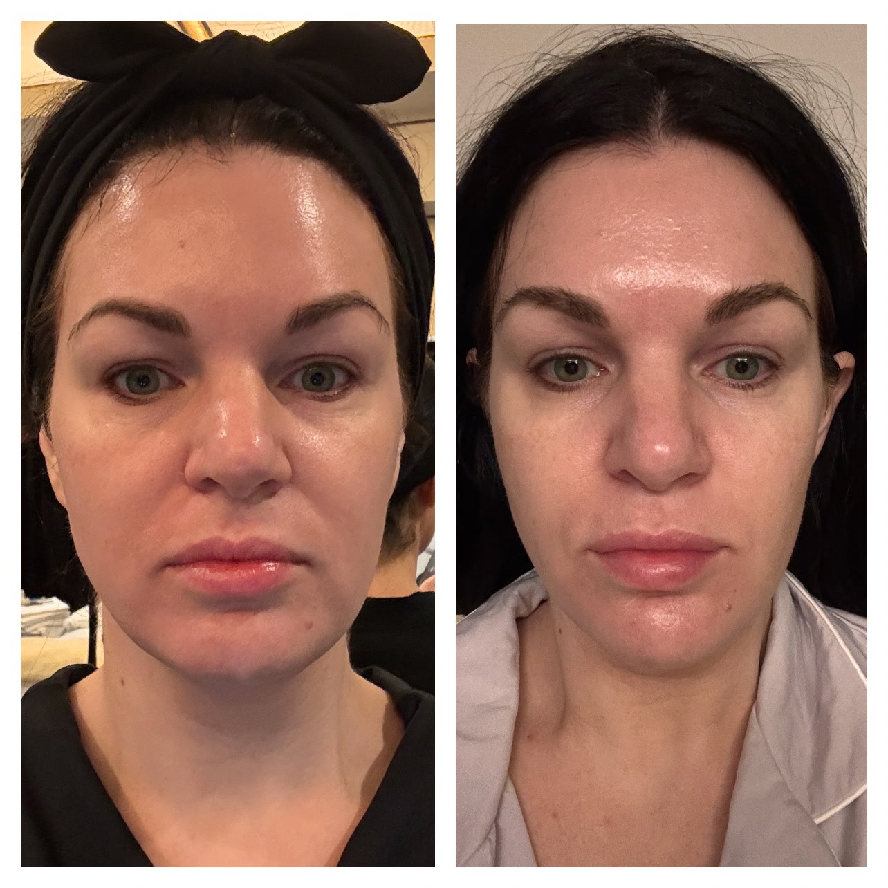 Before and after XERF treatment showing the lower face and jawline