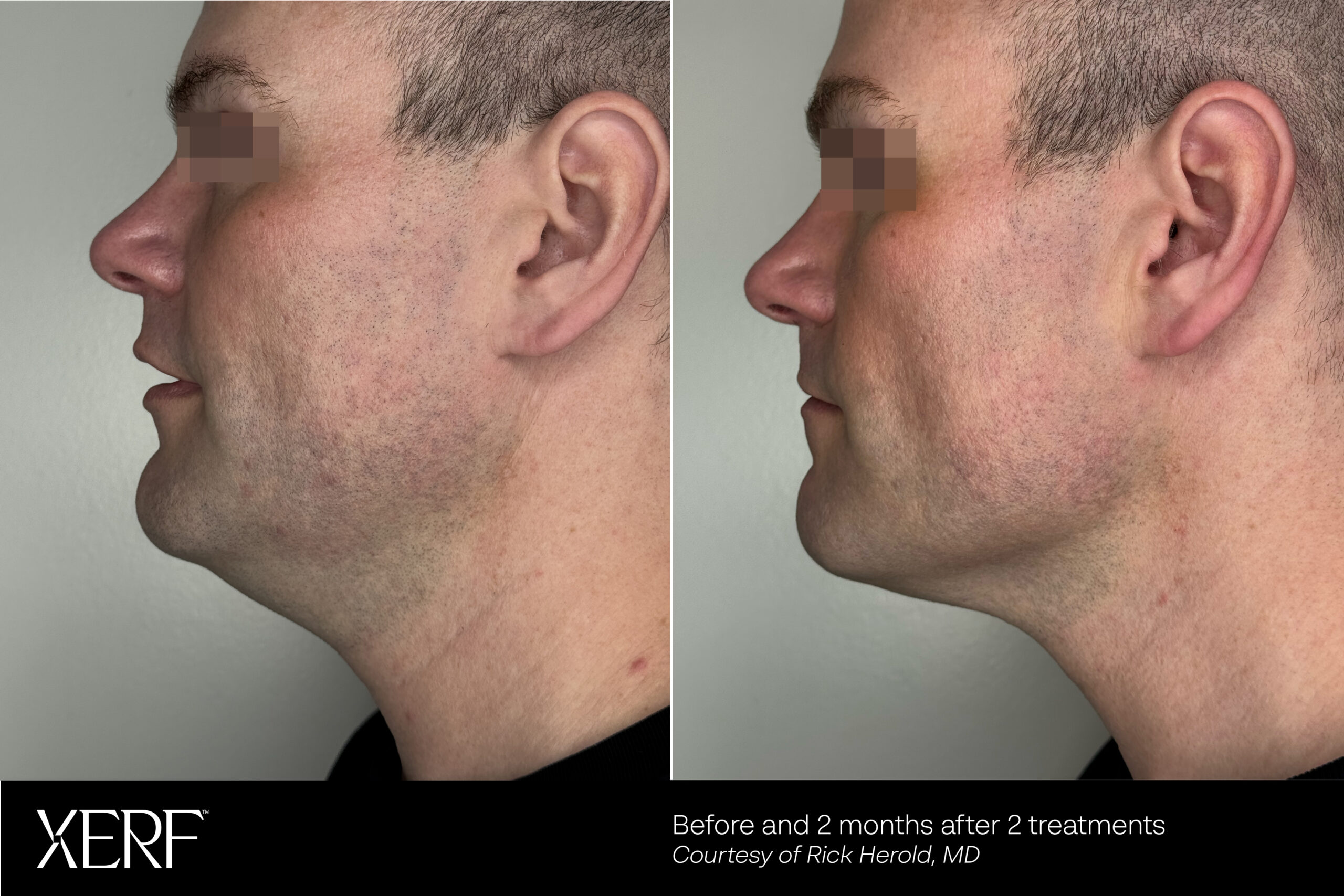 XERF before and after showing improved jawline definition two months after two treatments