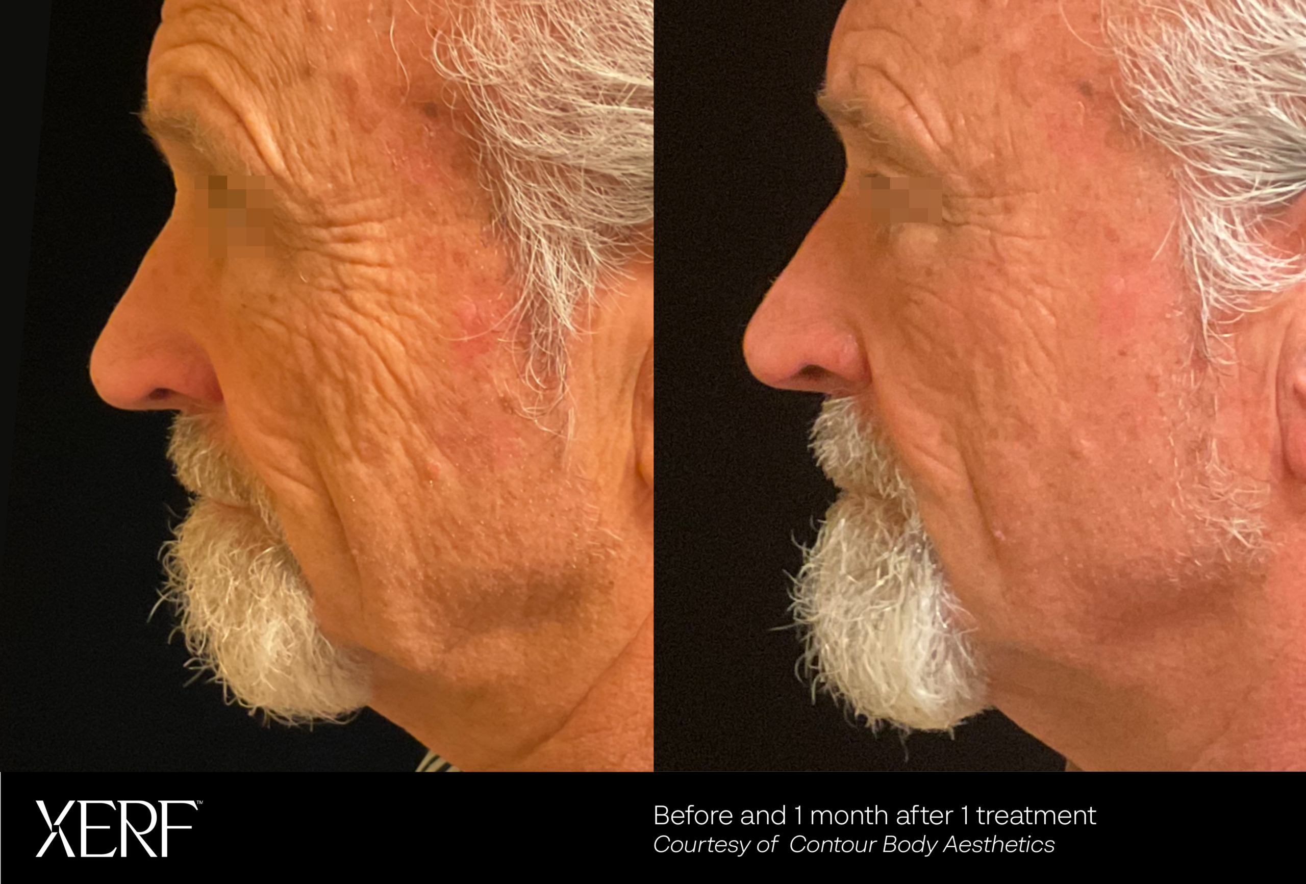 XERF before and after showing firmer-looking facial skin one month after one treatment