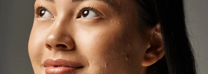 dreamy young asian woman with skin issues and bare shoulders looking up on grey background