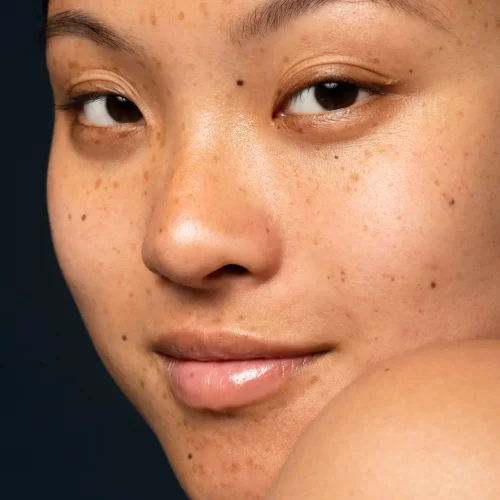 woman-with-skin-imperfections-side-view