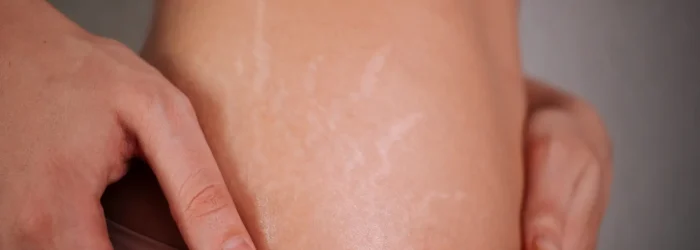 Young woman touching stretch marks on her body