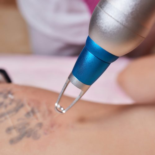 Young woman undergoing laser tattoo removal procedure in salon, closeup